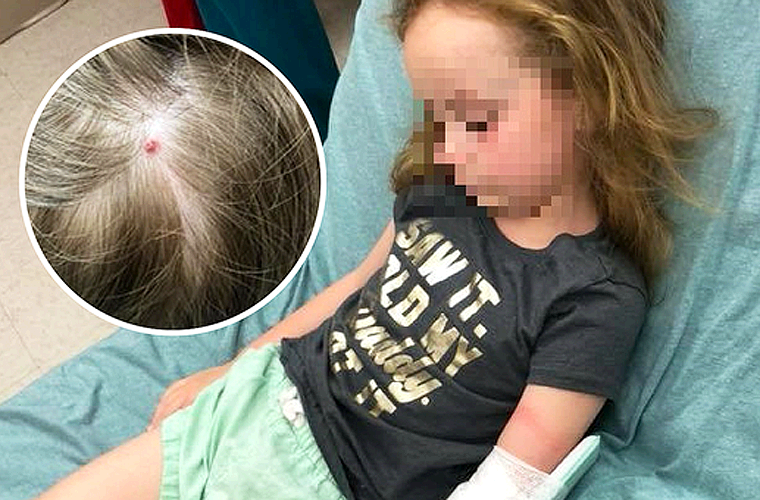 Niña es Paralizada por Garrapata