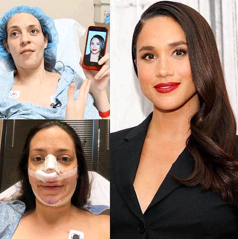 Se Opera Para Parecer a la Duquesa Megan
